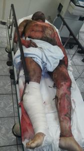 El mando policíaco presentaba heridas y quemaduras de tercer grado en varias partes del cuerpo, tras el atentado que sufrió esta mañana a la altura del tramo Tecolapan-San Andrés Tuxtla en la carretera 180.