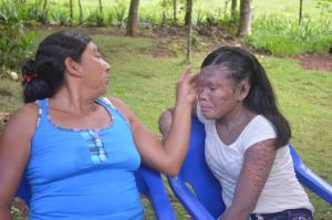 Pajapan concentra a nivel mundial el mayor número de casos de esta extraña enfermedad , en una misma localidad.