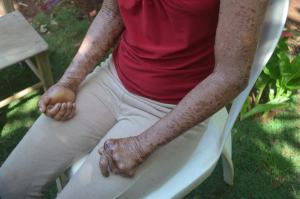 La ictiosis arlequín consume toda la piel, en una resequedad intensa. Incapacita manos y pies, por lo que los enfermos quedan incapacitados para trabajar.