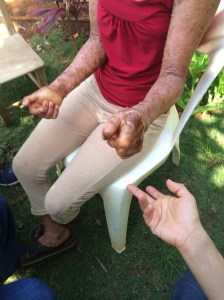 Presentan deformidad en sus manos